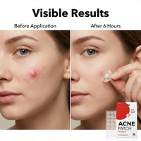 Invisible Hydrocolloid Acne Patches — 36-Piece Set